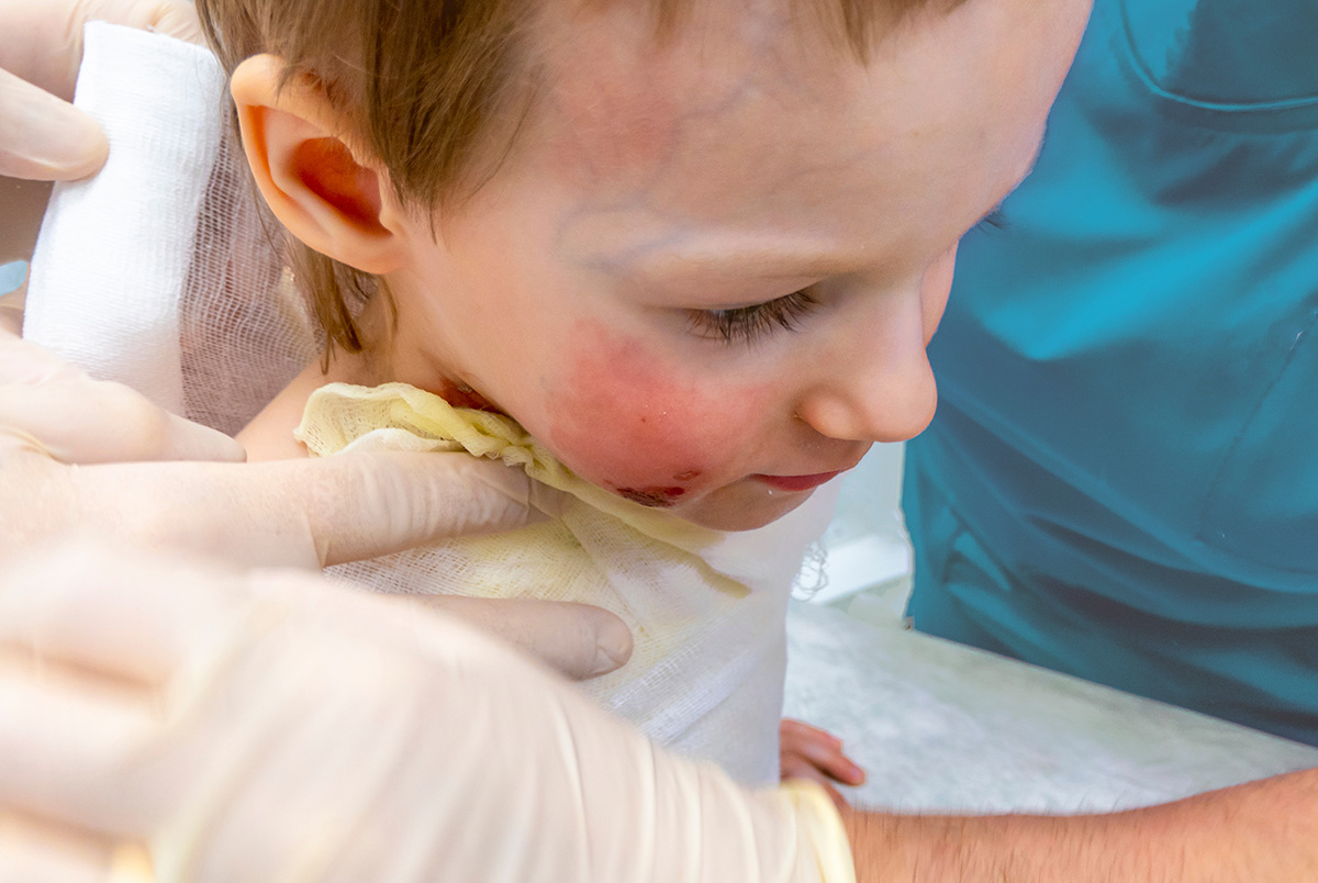 While a burn injury may not be the first thing you think of when you hear auto injury, motor vehicle accidents can cause severe burns.